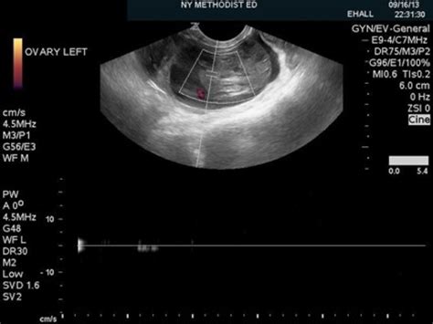 diagnostic test for ovarian torsion|fixation of a displaced ovary.